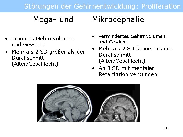 Störungen der Gehirnentwicklung: Proliferation Mega- und • erhöhtes Gehirnvolumen und Gewicht • Mehr als