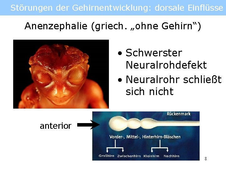 Störungen der Gehirnentwicklung: dorsale Einflüsse Anenzephalie (griech. „ohne Gehirn“) • Schwerster Neuralrohdefekt • Neuralrohr