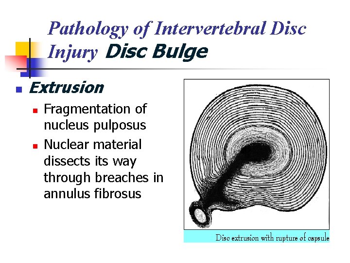 Pathology of Intervertebral Disc Injury Disc Bulge n Extrusion n n Fragmentation of nucleus
