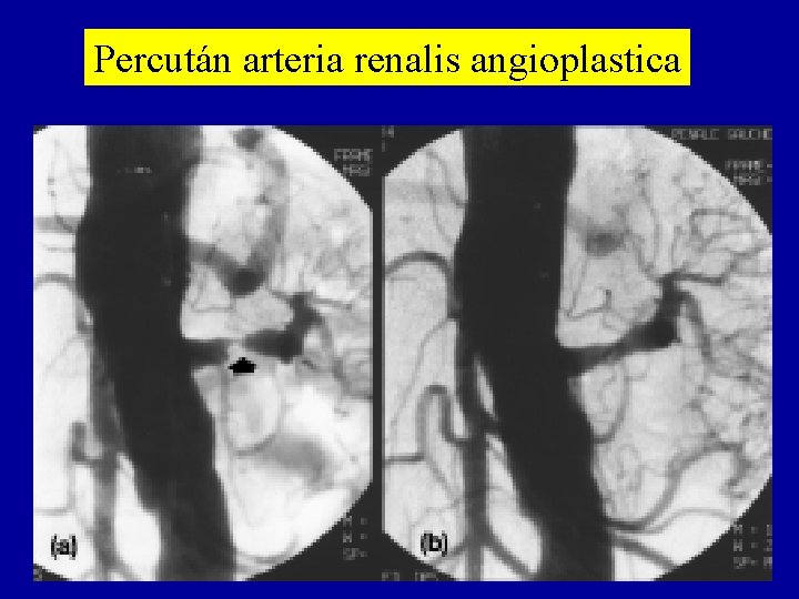 Percután arteria renalis angioplastica 