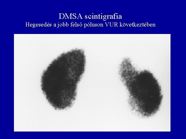 DMSA scintigrafia Hegesedés a jobb felső póluson VUR következtében 