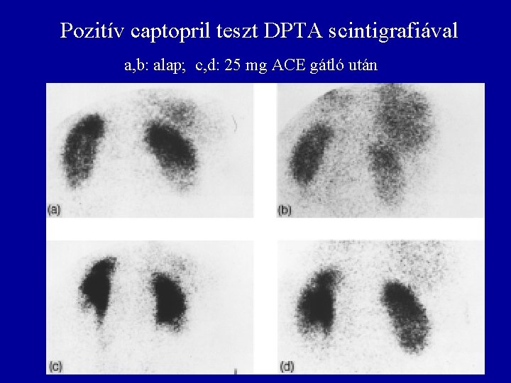 Pozitív captopril teszt DPTA scintigrafiával a, b: alap; c, d: 25 mg ACE gátló