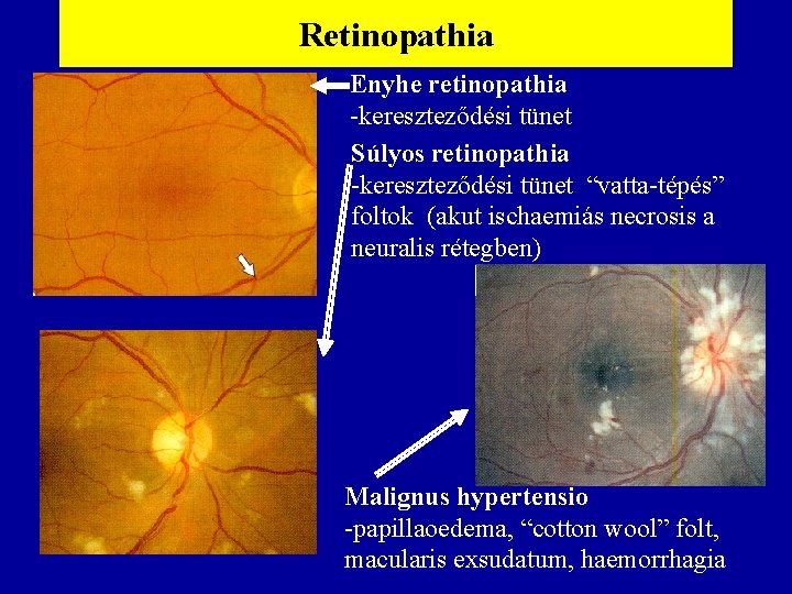 Retinopathia Enyhe retinopathia -kereszteződési tünet Súlyos retinopathia -kereszteződési tünet “vatta-tépés” foltok (akut ischaemiás necrosis