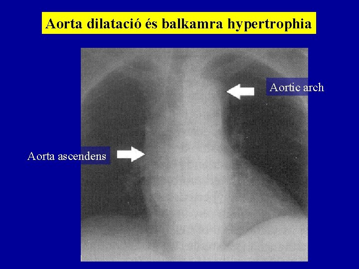 Aorta dilatació és balkamra hypertrophia Aortic arch Aorta ascendens 
