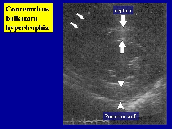 Concentricus balkamra hypertrophia septum Posterior wall 
