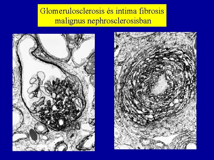 Glomerulosclerosis és intima fibrosis malignus nephrosclerosisban 