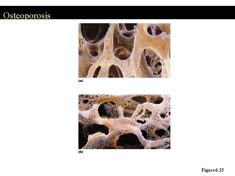 Osteoporosis Figure 6. 15 