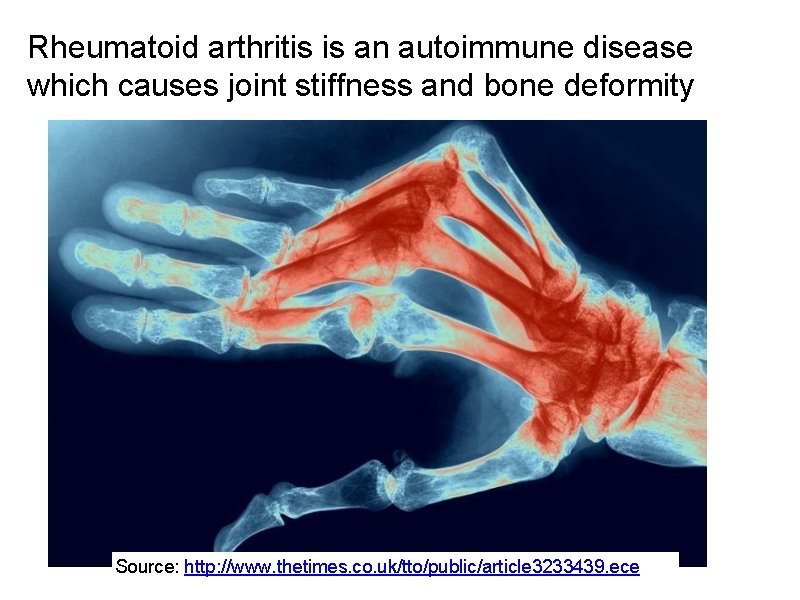 Rheumatoid arthritis is an autoimmune disease which causes joint stiffness and bone deformity Source: