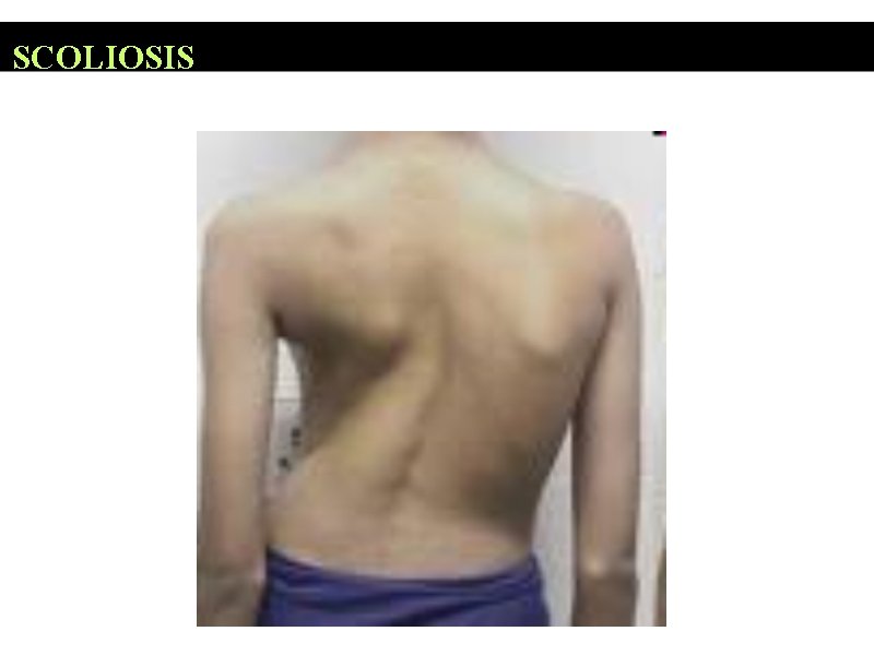 SCOLIOSIS 