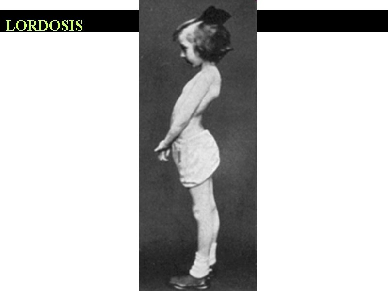 LORDOSIS 