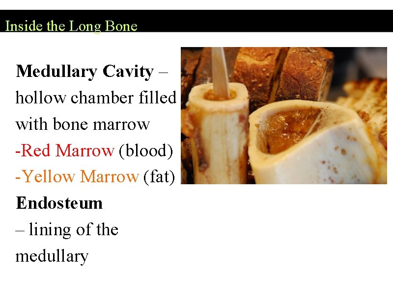 Inside the Long Bone Medullary Cavity – hollow chamber filled with bone marrow -Red