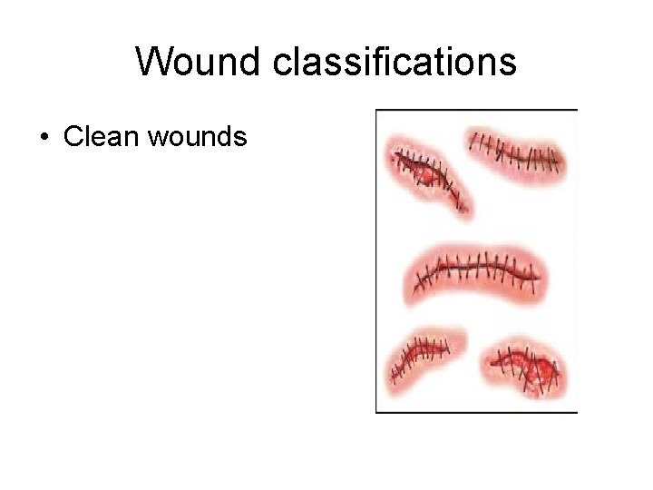 Wound classifications • Clean wounds 