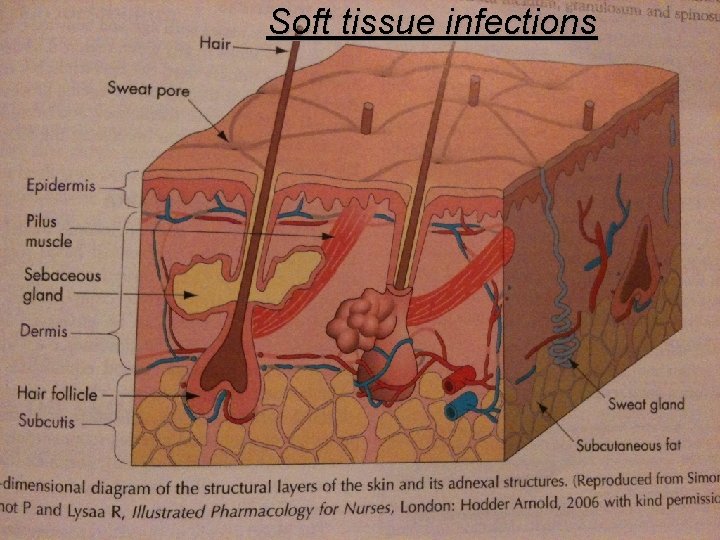 Soft tissue infections 