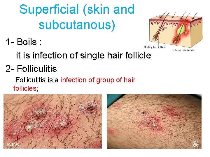 Superficial (skin and subcutanous) 1 - Boils : it is infection of single hair