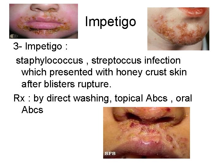 Impetigo 3 - Impetigo : staphylococcus , streptoccus infection which presented with honey crust