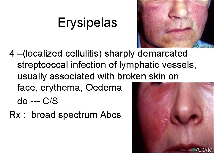 Erysipelas 4 –(localized cellulitis) sharply demarcated streptcoccal infection of lymphatic vessels, usually associated with