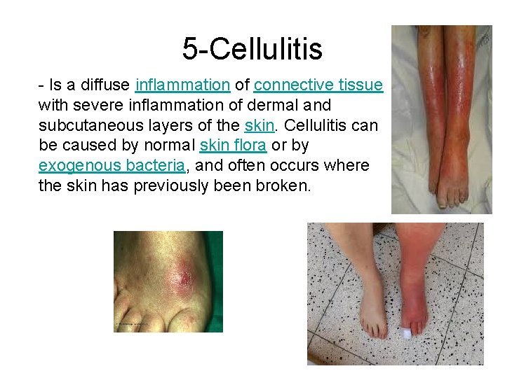 5 -Cellulitis - Is a diffuse inflammation of connective tissue with severe inflammation of