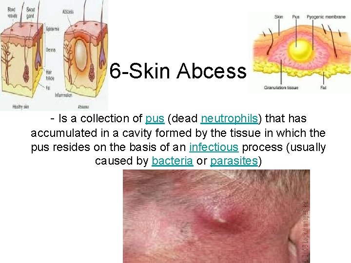 6 -Skin Abcess - Is a collection of pus (dead neutrophils) that has accumulated