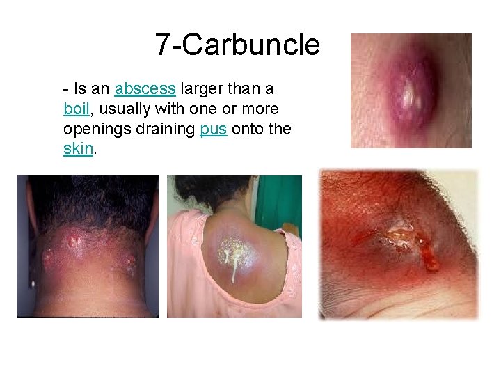 7 -Carbuncle - Is an abscess larger than a boil, usually with one or