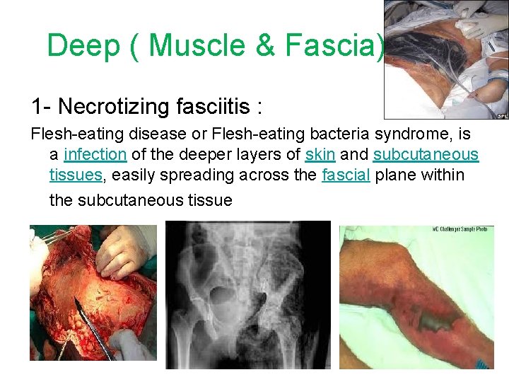 Deep ( Muscle & Fascia) 1 - Necrotizing fasciitis : Flesh-eating disease or Flesh-eating