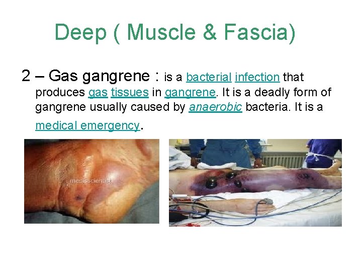 Deep ( Muscle & Fascia) 2 – Gas gangrene : is a bacterial infection