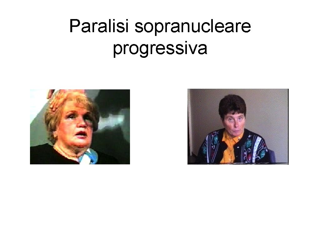 Paralisi sopranucleare progressiva 