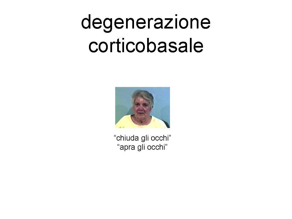 degenerazione corticobasale “chiuda gli occhi” “apra gli occhi” 