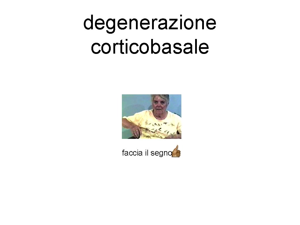 degenerazione corticobasale faccia il segno 