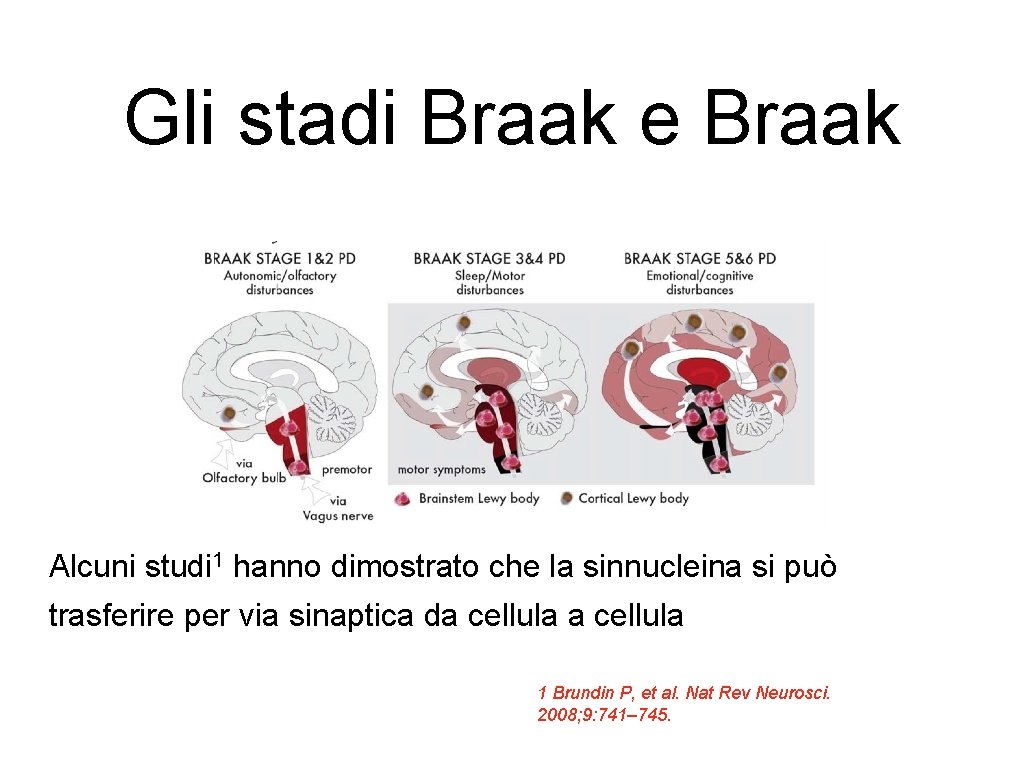 Gli stadi Braak e Braak Alcuni studi 1 hanno dimostrato che la sinnucleina si