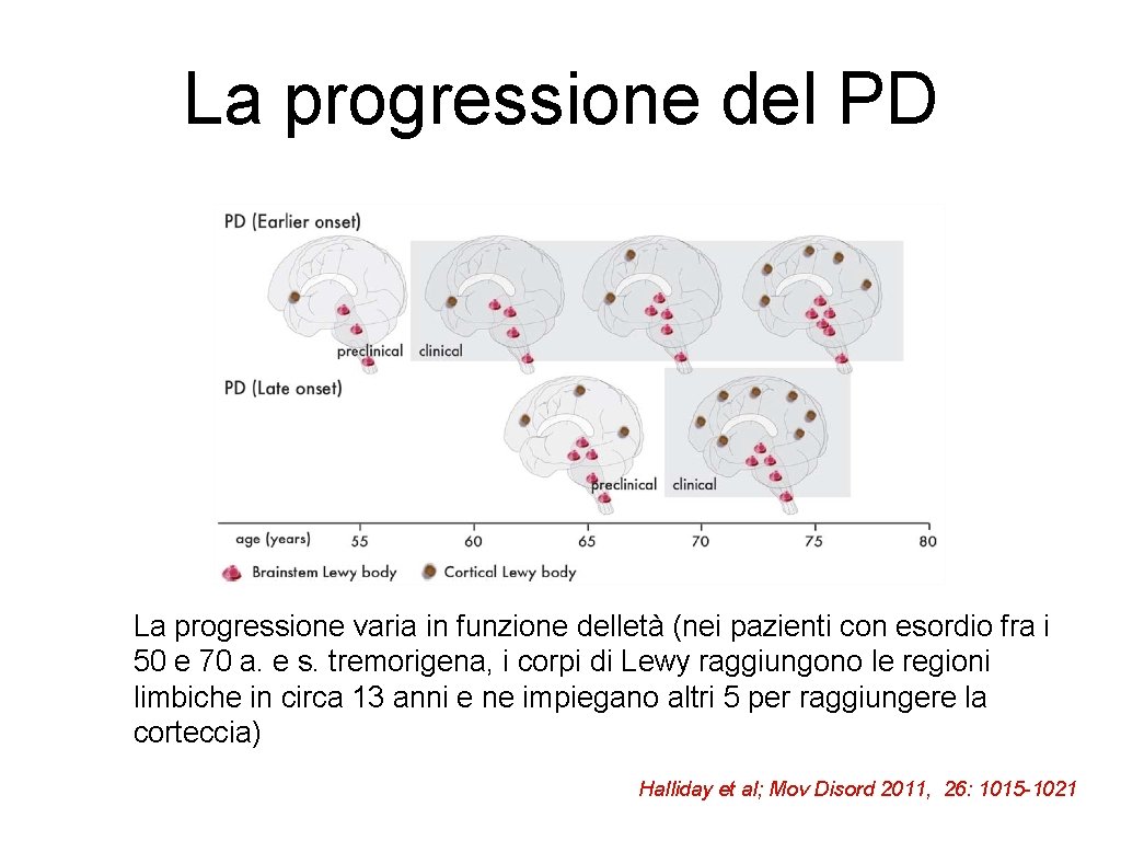 La progressione del PD La progressione varia in funzione delletà (nei pazienti con esordio