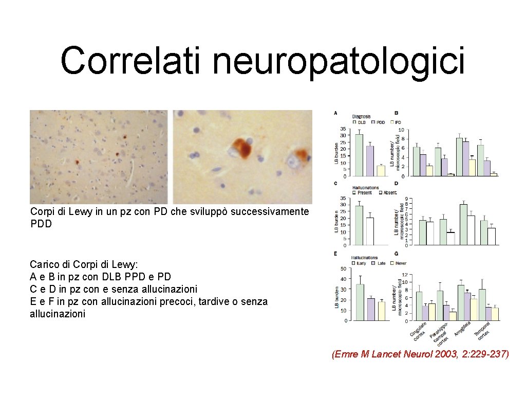 Correlati neuropatologici Corpi di Lewy in un pz con PD che sviluppò successivamente PDD