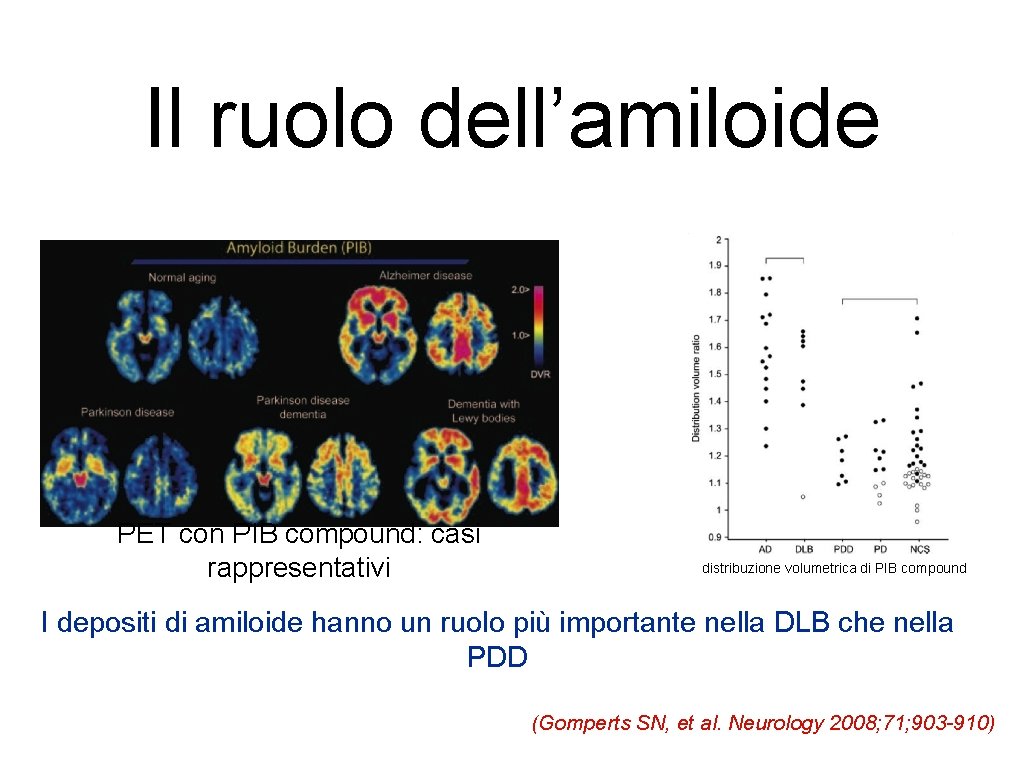Il ruolo dell’amiloide PET con PIB compound: casi rappresentativi distribuzione volumetrica di PIB compound