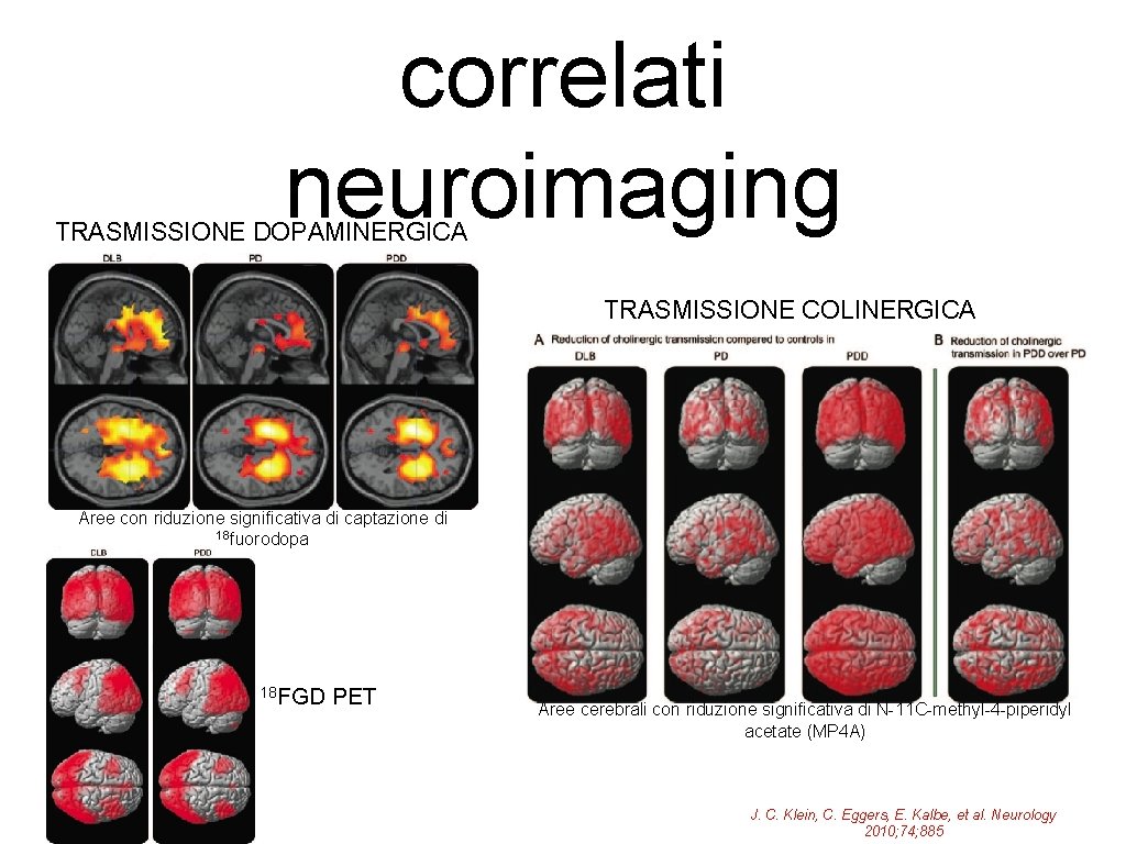 correlati neuroimaging TRASMISSIONE DOPAMINERGICA TRASMISSIONE COLINERGICA Aree con riduzione significativa di captazione di 18