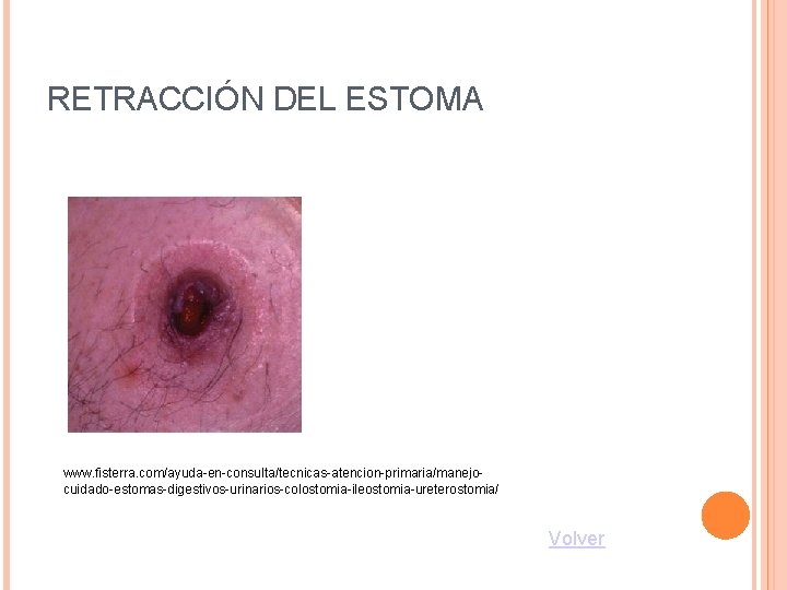 RETRACCIÓN DEL ESTOMA www. fisterra. com/ayuda-en-consulta/tecnicas-atencion-primaria/manejocuidado-estomas-digestivos-urinarios-colostomia-ileostomia-ureterostomia/ Volver 