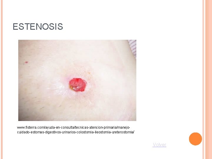 ESTENOSIS www. fisterra. com/ayuda-en-consulta/tecnicas-atencion-primaria/manejocuidado-estomas-digestivos-urinarios-colostomia-ileostomia-ureterostomia/ Volver 