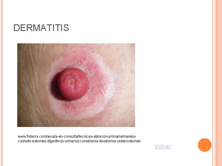 DERMATITIS www. fisterra. com/ayuda-en-consulta/tecnicas-atencion-primaria/manejocuidado-estomas-digestivos-urinarios-colostomia-ileostomia-ureterostomia/ Volver 