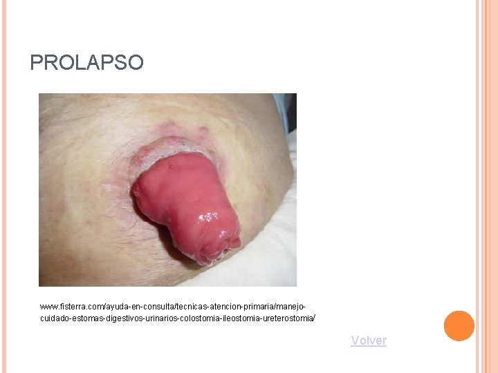PROLAPSO www. fisterra. com/ayuda-en-consulta/tecnicas-atencion-primaria/manejocuidado-estomas-digestivos-urinarios-colostomia-ileostomia-ureterostomia/ Volver 