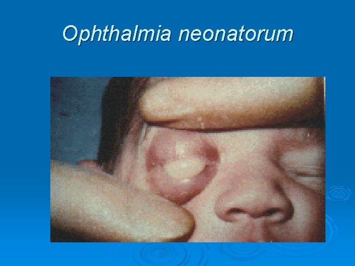 Ophthalmia neonatorum 