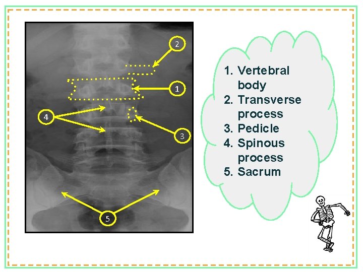 2 1 4 3 5 1. Vertebral body 2. Transverse process 3. Pedicle 4.