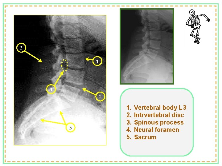 3 1 4 2 5 1. 2. 3. 4. 5. Vertebral body L 3