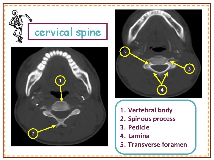 cervical spine 3 5 1 4 2 1. 2. 3. 4. 5. Vertebral body