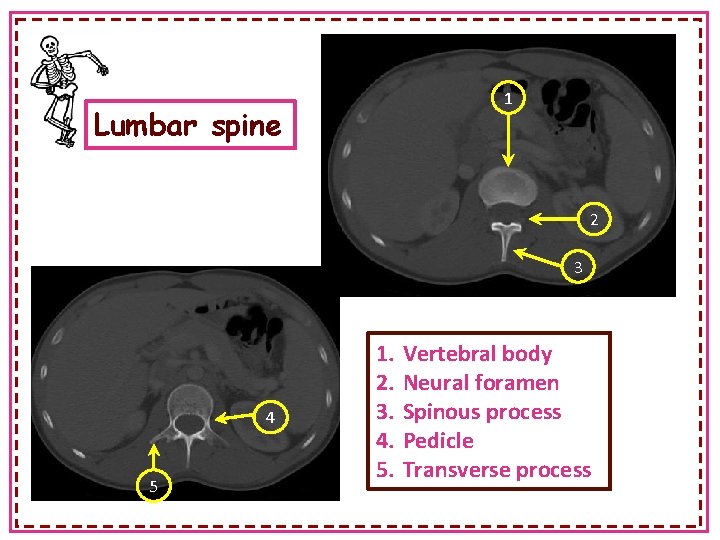 1 Lumbar spine 2 3 4 5 1. 2. 3. 4. 5. Vertebral body