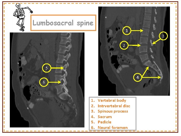 Lumbosacral spine 1 3 2 5 4 6 1. 2. 3. 4. 5. 6.