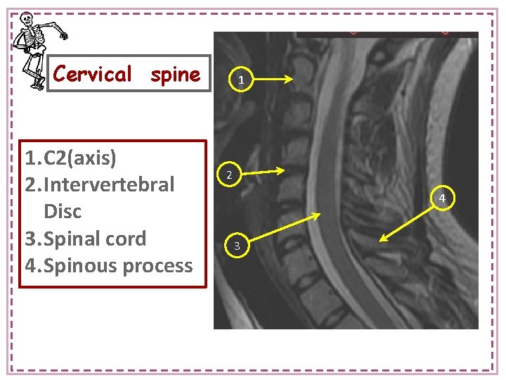 Cervical spine 1. C 2(axis) 2. Intervertebral Disc 3. Spinal cord 4. Spinous process