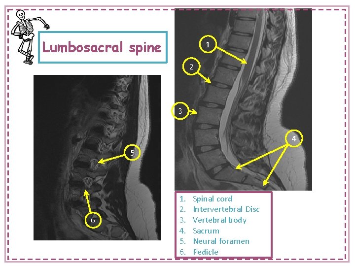 Lumbosacral spine 1 2 3 4 5 6 1. 2. 3. 4. 5. 6.
