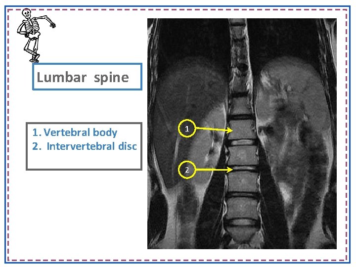 Lumbar spine 1. Vertebral body 2. Intervertebral disc 1 2 