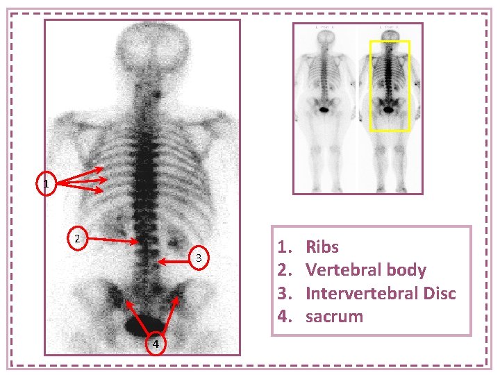 1 2 3 4 1. 2. 3. 4. Ribs Vertebral body Intervertebral Disc sacrum