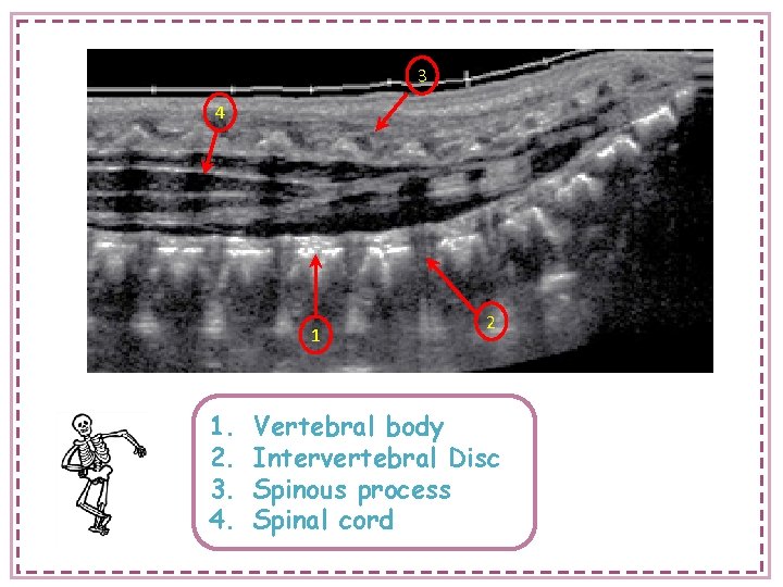 3 4 1 1. 2. 3. 4. 2 Vertebral body Intervertebral Disc Spinous process