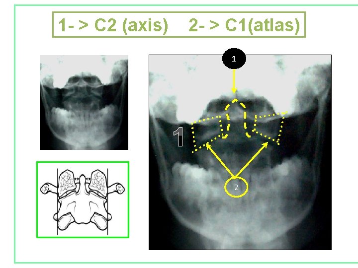 1 - > C 2 (axis) 2 - > C 1(atlas) 1 1 2