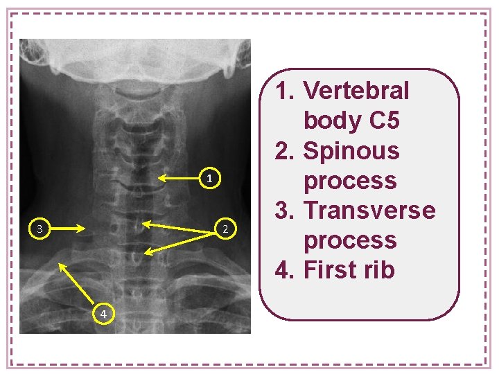 1 3 2 4 1. Vertebral body C 5 2. Spinous process 3. Transverse